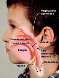 Mon enfant est né avec une fente labio-palatine