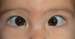 Eyerounds Org Ophthalmology The University Of Iowa Eye Health Pediatric Ophthalmology Eyes