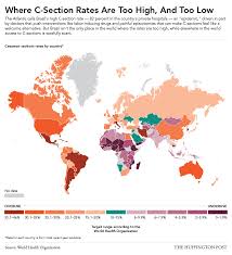 Brazil Isn T The Only Country With A Startlingly High C Section Rate Cesareansection Cesarean Cesarean Section C Section
