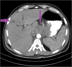 Symptoms of advanced stomach cancer are more. Diagnosis Of Gastric Cancer By Mdct Gastrography Diagnostic Characteristics And Management Potential Egyptian Journal Of Radiology And Nuclear Medicine Full Text
