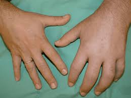 Complex Regional Pain Syndrome What S It All About And How Can We Help Physio On The River