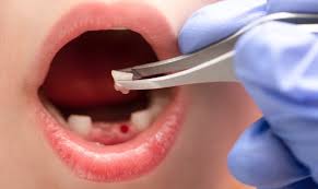 Image result for Tooth Avulsion