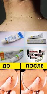 масло чайного дерева от грибка ногтей на ногах отзывы Mazi Ot Papillom Na Shee Mazi Na Ot Papill Mazi Na Ot Papill Papillom Shee Hausmittel Nagelpilz Hausmittel Gesundheit Und Schonheit