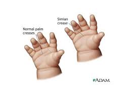 If you have a single transverse palmar crease (stpc), the distal and proximal creases combine to form one transverse palmar crease. Simian Line Crease