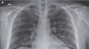 Secuelas Del Coronavirus Recuperados Pero Con Pulmones Danados Asociacion Medica Latinoamericana De Rehabilitacion