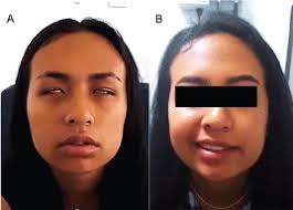 We did not find results for: Idiopathic Bilateral Facial Palsy Diagnostic And Therapeutic Approach In A Female Young Patient Case Report