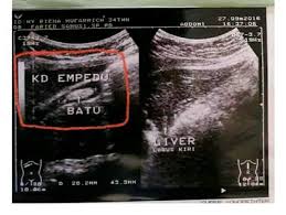 Segera periksakan diri ke dokter jika anda mengalami gejala di atas atau gejala yang muncul disertai demam. Testimoni Batu Empedu Semoga Kangen Water Kota Tegal Facebook