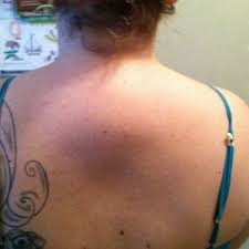 If i sit down here will you hump me? My Doctor Told Me I Have A Lipoma On The Back Of My Neck What Are The Risk Of Surgery