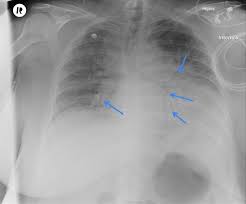 La légionellose est due à des bactéries. Nosokomiale Pneumonie Abstract Europe Pmc