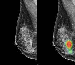 Accumulations of blood or other fluids where they do not belong may be detected. Ai Assisted Radiologists Can Detect More Breast Cancer With Reduced False Positive Recall Imaging Technology News