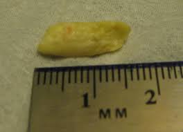 Image result for tonsilith