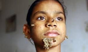 Tree man syndrome, formally known as epidermodysplasia verruciformis (ev), is a rare but physically and mentally taxing condition that causes warts that resemble tree branches to spread all over the body at rapid rates. Talk Disease Shahana Khatun From Netrakona Is The First Female With Tree Man Syndrome