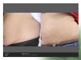 Pulsed dye lasers, such as vbeam. Laser Stretch Mark Removal With Icon Accessmedicine Direct Primary Care