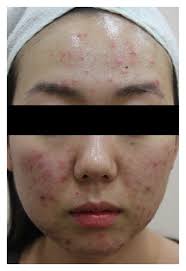 Photographs of a representative patient with acne (a) before treatment...