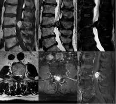 Cauda equina syndrome (ces) refers to a group of symptoms that occur when nerves in the cauda equina (a collection of nerve roots that spread out ces can be difficult to diagnose since symptoms vary and they may mimic other conditions. Cauda Equina Syndrome Pacs Entwicklung