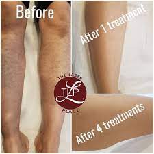Drop the razor, and never shave again! Queens Laser And Electrolysis Hair Removal 30 Photos 77 Reviews Laser Hair Removal 87 08 Justice Ave Elmhurst Ny United States Phone Number Yelp