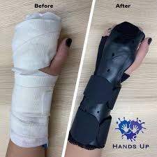 Image result for Radial Gutter Cast