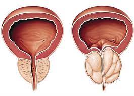التهاب في البروستات بل والتهاب مزمن ولا يشكون من أي آلام أو أعراض، وهناك أيضاً من يشكو من آلام وأعراض التهاب غدة البروستاتا مع أن التحاليل المخبرية لا تظهر أي جراثيم. Ø§Ù„Ø¨Ø±ÙˆØ³ØªØ§ØªØ§ Ù…Ø±Ø¶ Ø§Ù„Ø±Ø¬Ø§Ù„ Ø§Ø¨ØªØ¹Ø¯ÙˆØ§ Ø¹Ù† Ø§Ù„Ø¥ÙØ±Ø§Ø· ÙÙŠ 3 Ø¹Ø§Ø¯Ø§Øª Ø§Ù„Ù…ØµØ±ÙŠ Ø§Ù„ÙŠÙˆÙ…