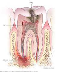 Tooth Abscess Symptoms And Causes Mayo Clinic Abscess Tooth Dental Videos Tooth Infection