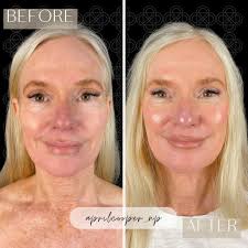 Got crepey skin? Look what hyperdilute Radiesse can do! This client of mine  is quite fit with muscle definition in her arms but no one can escape the  loss of collagen and