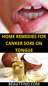 Home Remedies For Canker Sore On Tongue In 2020 Tongue Sores Canker Sore Canker Sore Remedy