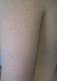 Image result for Keratosis pilaris