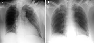 A rare cause of cardiac dextroposition in the fetus. Lung Hyperlucency Chest
