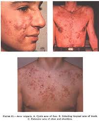 People with acne may stop hanging out with friends and. Acne Wikipedia