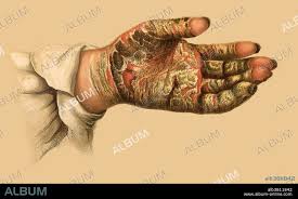 Image result for scabies norvegica