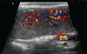 It is diagnosed clinically and by thyroid auto antibodies such as antithyroglobulin antibodies and antithythroid microsomal antibodies. Doppler Ultrasonography In The Diagnosis Of Graves Disease A Non Invasive Widely Under Utilized Diagnostic Tool Annals Of Saudi Medicine