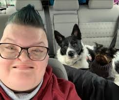 Anna lever med en ovanlig kraniofacial diagnos