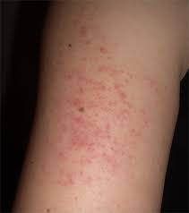 People usually don't get sick enough to go to the hospital, and they very rarely die of zika. Would You Know A Zika Rash If You Saw It Captureproof