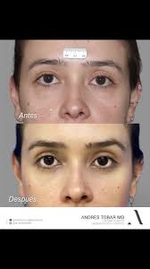 Blefaroplastia ANDRÉS TOBAR PADILLA MD Cirujano Plástico Reconstructivo y  Estético 👃🏻👱🏼‍♀️ Cirugia Plastica facial 💉👄Botox y ácido hialuronico  👙👙Cirugía Plástica Corporal #blefaroplastia ...