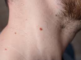 Tienes Verrugas En El Cuello Hay Algo Que Quieren Decirte De Tu Salud Estilo De Vida Bienestar Univision