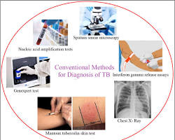 Image of tuberculosis diagnostic methods