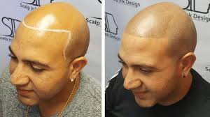 Before and After Photos of Scalp Micropigmentation (SMP)