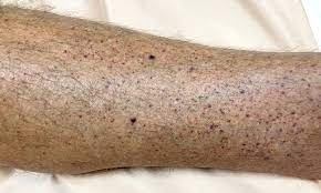 Idiopathic thrombocytopenic purpura (itp) merupakan suatu penyakit yang belum diketahui pasti 6. Immune Thrombocytopenic Purpura Patofisiologi Diagnosis Penatalaksanaan Alomedika
