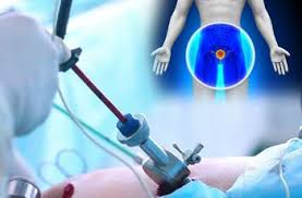 Credihealth team can help you find the best urologist in mumbai. Low Cost Urology Surgery India Get Cost Effective Laparoscopic Urology Surgery At Top Laparoscopic Urology Treatment Hospitals India