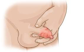 Image result for balanoposthitis