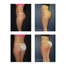 However, the cost can range from $2,300 to $10,800. Your Brazilian Butt Lift Bbl Before And After Photos Matthew Schulman M D Plastic Surgeon