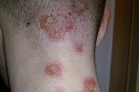 Image result for sores on the head in children