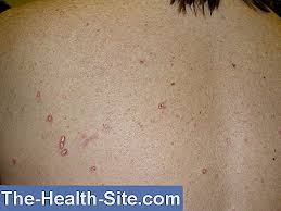 Această boală este asemănătoare cu lupusul sistemic, însă este cauzată de respingerea anumitor medicamente de către lupusul nu se vindecă, însă pacientul poate răspunde foarte bine la tratament. Tratamentul Articular Al Lupusului Eritematos Tratament De Recuperare In Cadrul Manifestarilor Osteo Articulare In Lupus