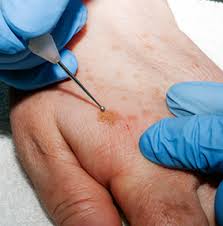 If one of your parents or a sibling has had skin cancer, you may have an increased risk of the disease. Skin Cancer Treatment At Dermcare Mississauga Dermcare