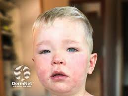 Image result for Angioedema