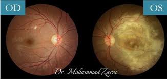 Image result for HIV Retinitis