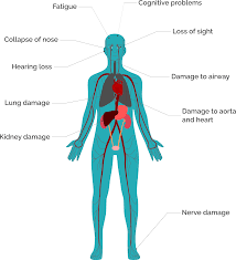Image result for Vasculitis
