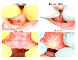 Does my baby have a tongue tie? Tongue And Lip Ties What Are They And How Can They Affect Breastfeeding This Lovely Little Farmhouse