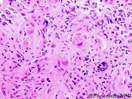 People with a normal immune system are not likely to get infectious esophagitis. Webpathology Com A Collection Of Surgical Pathology Images