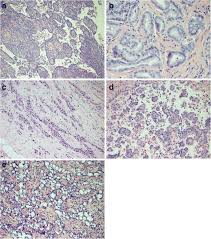 Pleural Mesothelioma Classification Update Springerlink