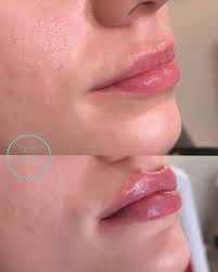 Beautiful lip enhancement 💋💋💋💋💋💋💋💋💋 To see: Me 👩🏼‍⚕️Holly Fahey  RN, BSN, C-ANS @nurse_holly_skinesteem 👩🏻‍⚕️Dawn Naylor RN, BS,MSN,  NP-BC, CANS @skinesteemmedspa 👩🏼‍⚕️Lindsay Trudeau RN,BSN,FNP-BC, CANS  @lindsaynp_skinesteem ...